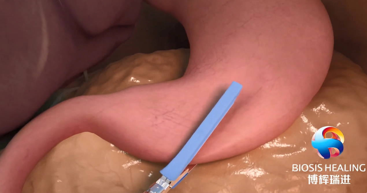 Усиление линии скоб (SLR) для уменьшения утечек