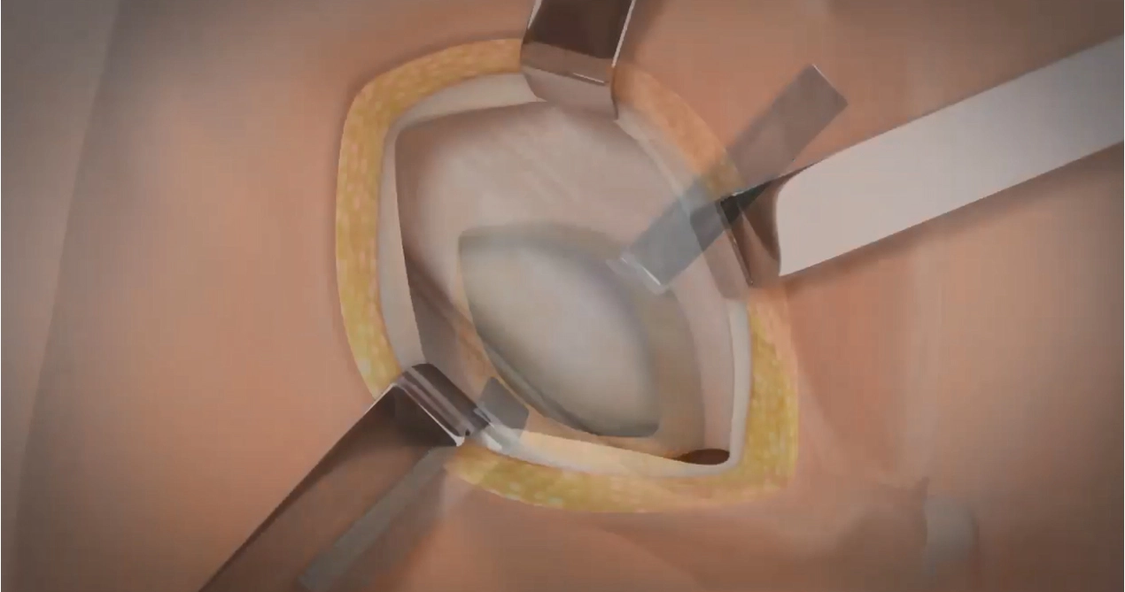Лихтенштейн ремонт грыжи с SIS Рассасывающиеся сетки