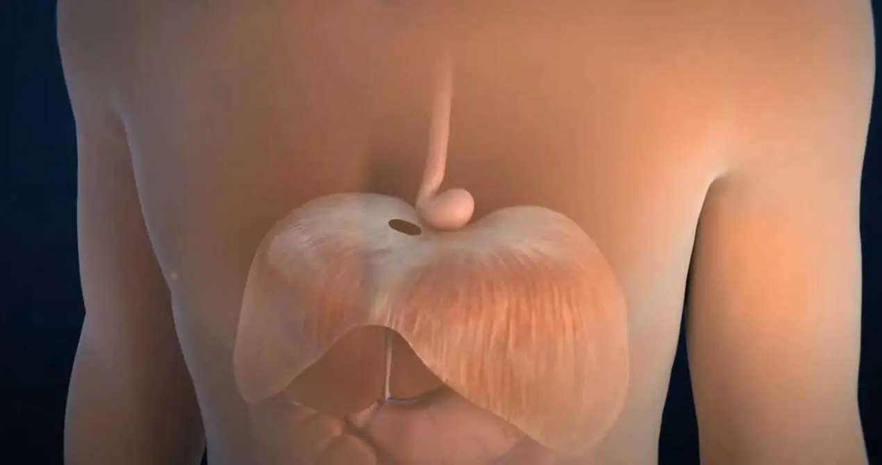 Восстановление грыжи пищевода Hiatus с помощью биологических сеток SIS