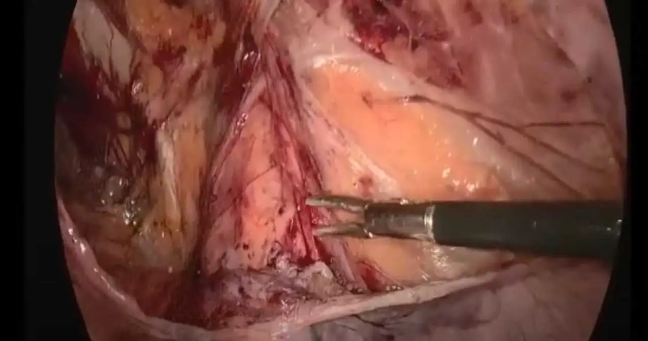 SIS Биологическая сетка 13x15 см TAPP Хирургия для восстановления грыжи