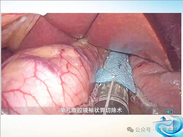 laparoscopic sleeve gastrectomy